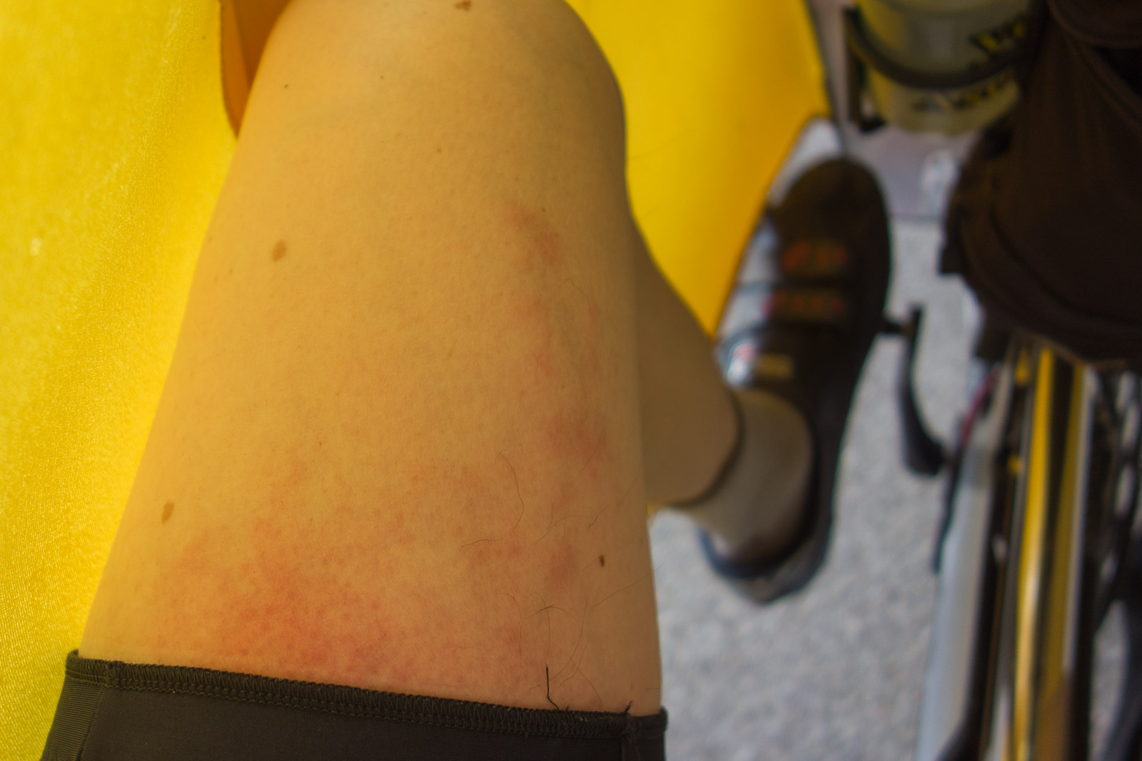 I get this on my thighs when the hot sun shines directly down on my thighs.  It's not sunburn but a rash due to heat.  Unfortunately, sunscreen doesn't block infrared radiation.